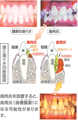 歯肉炎のメカニズム 歯肉炎を放置すると、歯周炎（歯槽膿漏）になる可能性があります。
