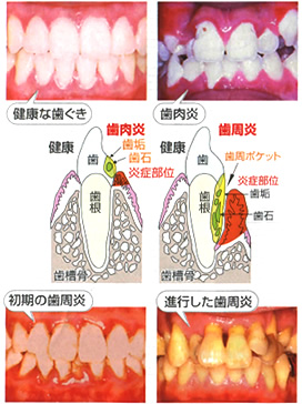 歯周炎のメカニズム