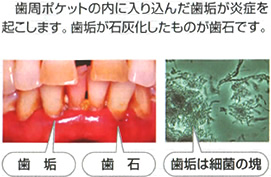 歯周ポケットの内に入り込んだ歯垢が炎症を起こします。歯垢が石灰化したものが歯石です。