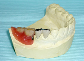 コーヌス義歯